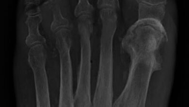 التهاب العظم والنقي