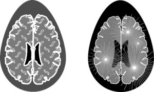 أنواع التصلب المتعدد
