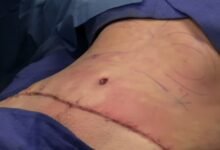 Abdominoplasty عملية شد البطن