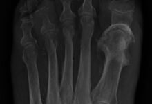 osteomyelitis