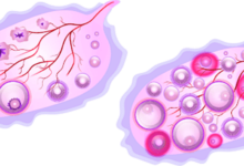 علاج تكيس المبايض