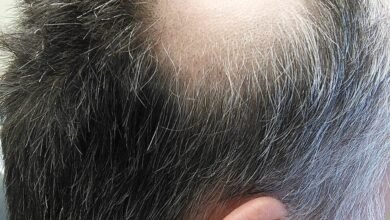 مرض الثعلبة