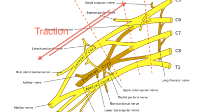 Brachial plexus birth injury