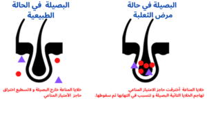 مرض الثعلبة