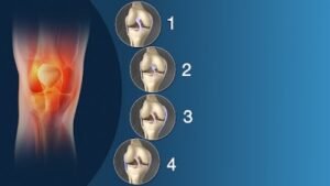 أعراض تمزق الأربطة