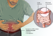 علاج القولون العصبي