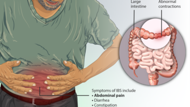 علاج القولون العصبي
