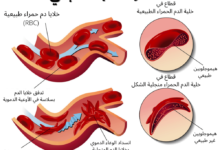 فقر الدم المنجلي