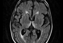 متلازمة كورساكوف