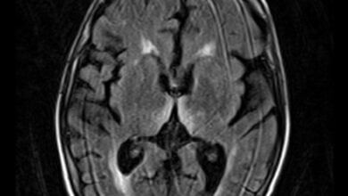 متلازمة كورساكوف