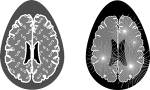 Multiple sclerosis diagnosis