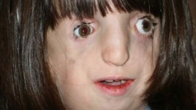 متلازمة تريتشير كولينز