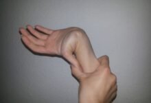 متلازمة مارفان