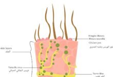 علاج الجدري المائي في الأطفال