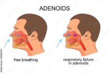 أضرار عملية اللحمية في الأنف