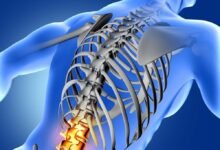 التهاب الفقار المقسط