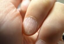 علاج تقصف الأظافر