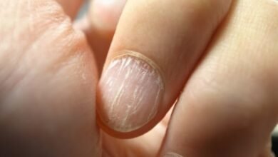 علاج تقصف الأظافر