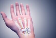 علاج متلازمة النفق الرسغي بالتمارين