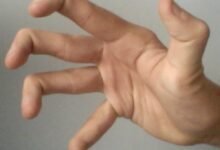 متلازمة اهلرز دانلوس