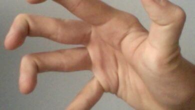 متلازمة اهلرز دانلوس