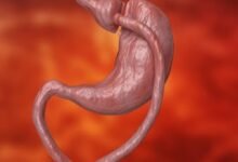 عملية قص المعدة