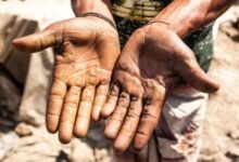 اكتشف طرق علاج الكالو نهائيا دون ألم