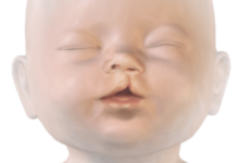 اسباب الشفة الارنبية عند الاطفال