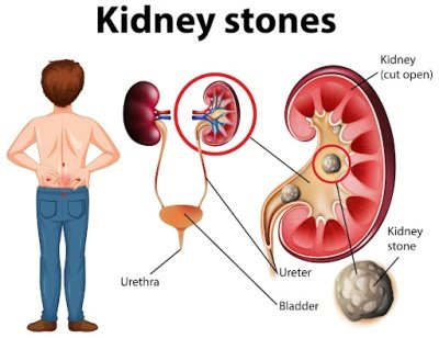 ما هي دواعي استعمال دواء Cystone؟