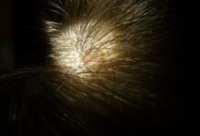 أسباب فطريات فروة الرأس