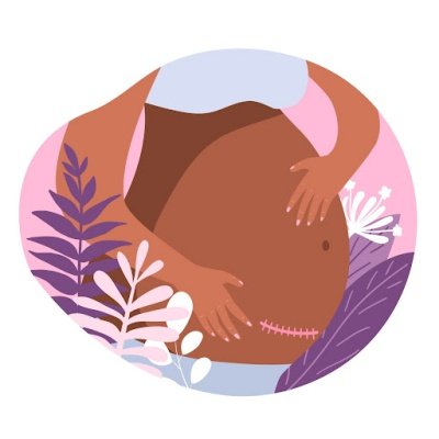 ما هو جهاز PCA للولاده؟ ما هو جهاز PCA للولاده؟