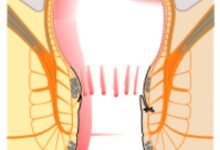 مرهم gtn لعلاج الشرخ الشرجي