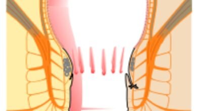 مرهم gtn لعلاج الشرخ الشرجي