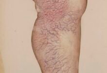 دواء varixinal